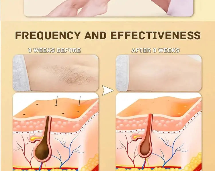 Body Bikini IPL 500,000 Flash épilateur impulsions épilateur Laser mylalla cacyra